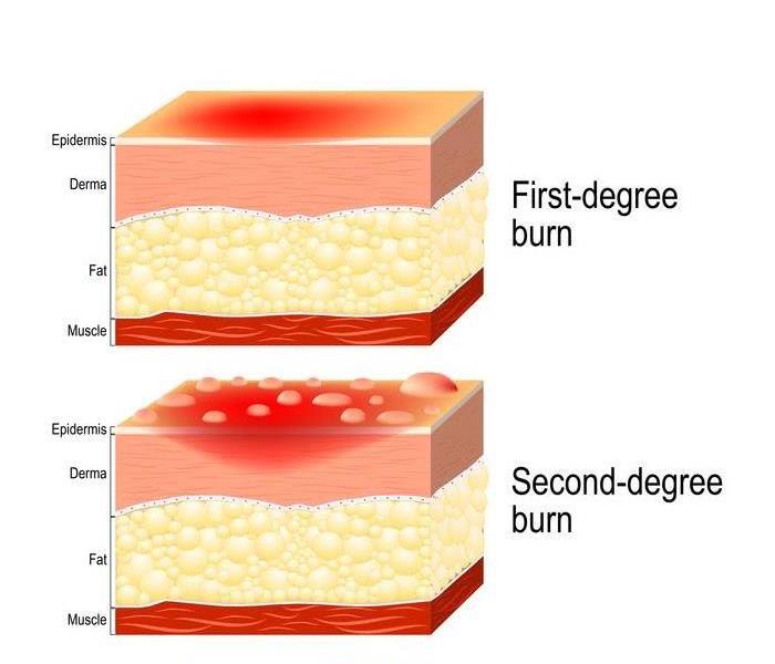 Types of burn injuries